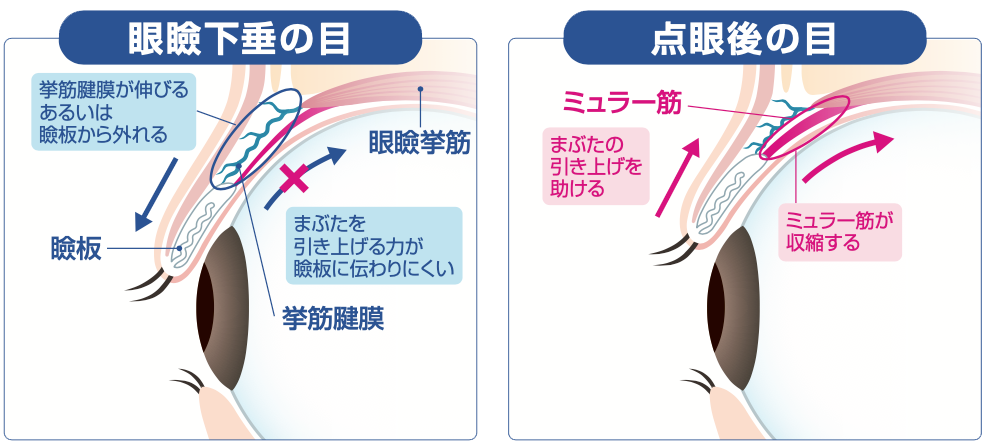 アップニーク点眼液のはたらき